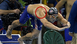 Die Schröpfabdrücke von Phelps: Der 19fache Goldmedaille-Besitzer liebt TCM